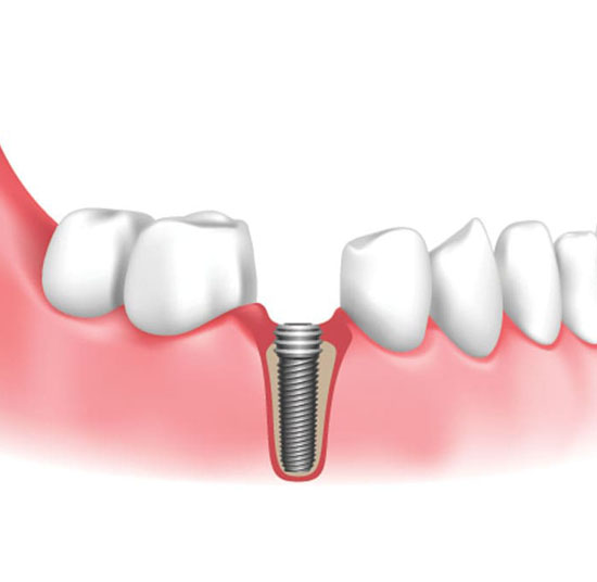 Implantology